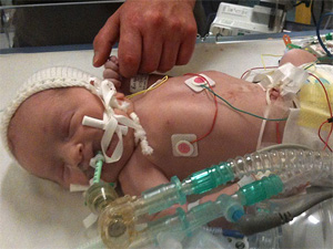 Новонароджене дитя, яке народилось без крові, вдалось врятувати