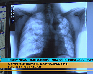 День боротьби з туберкульозом відзначили у Коломиї (відео) День боротьби з туберкульозом відзначили у Коломиї (відео)